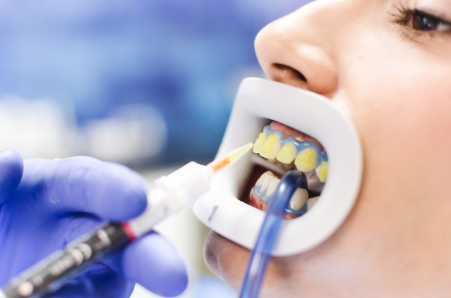 オフィスホワイトニングの施術の様子